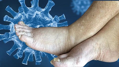 Lymphatic Filariasis