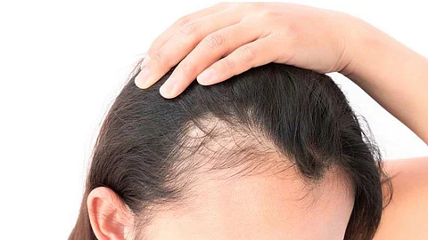 Hair transplant