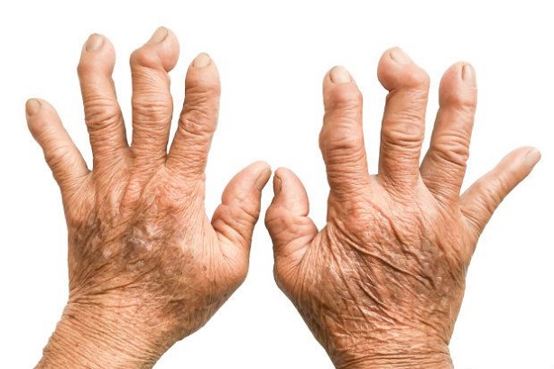 Rheumatoid arthritis - Symptoms and causes