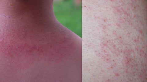 Prickly Heat Home Remedies