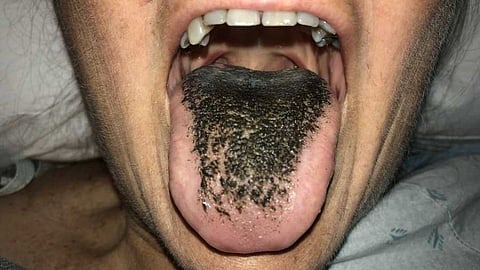 hairs on Tongue