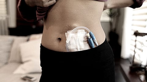 crime news Ruby Hall Clinic kidney transplant case Two agents arrested pune