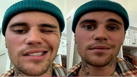 Justin Bieber says he is suffering from facial paralysis