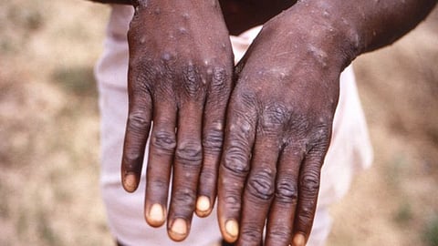Monkeypox