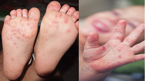 child health Enteroviruses Hand foot mouth infection health news pune