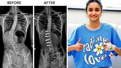Scoliosis Surgery