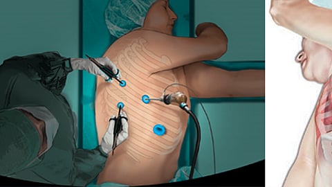 Thoracoscopy surgery