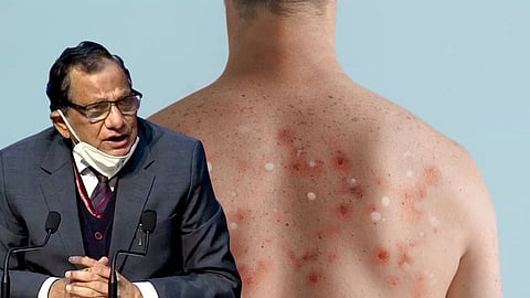 Monkeypox Vaccine Marathi News