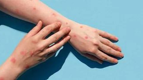 monkeypox Marathi News