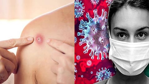 MonkeyPox Vs. Corona