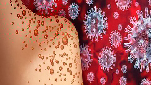 Monkeypox, Corona Latest News