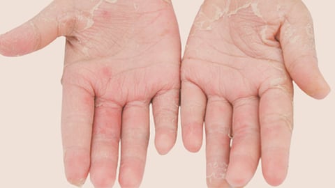 Monsoon infections