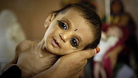 Jalgaon News : जळगावची वाटचाल कुपोषणमुक्तीकडे : जिल्हाधिकारी प्रसाद