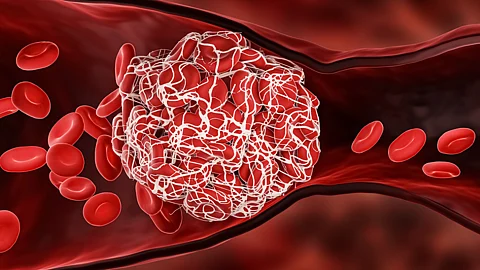 Period clots