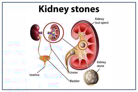 health kidney stone