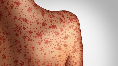 Measles Infection