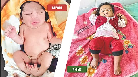 A child with divyang (crooked legs). In the second photo, the child straighten his leg after treatment.