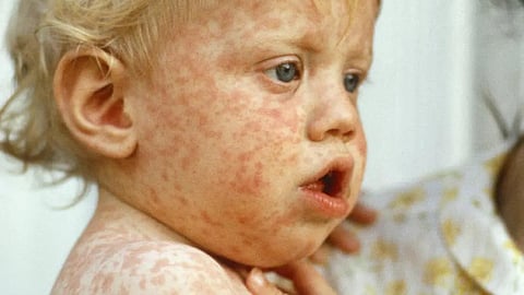 Measles