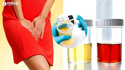 Urine colour Change