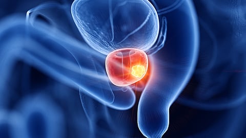 Prostate Cancer