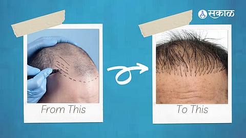 Hair Transplant Failure
