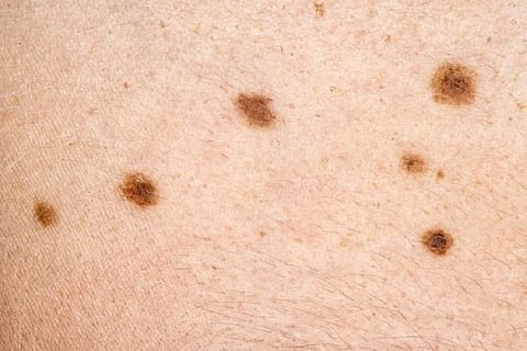 Skin Cancer Rumors
