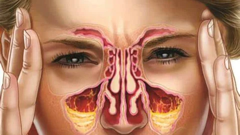 Sinus Problem