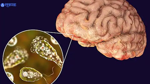 Brain Eating Amoeba