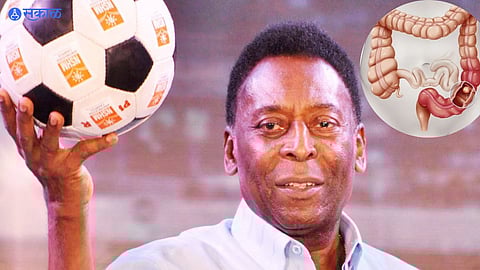 Pele Colorectal Cancer