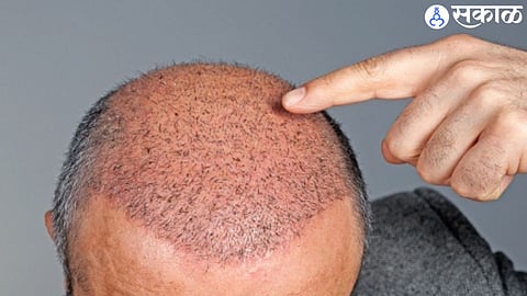 Hair Transplant