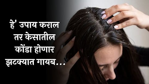 Dandruff Remove
