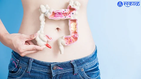 Colon Cancer Causes