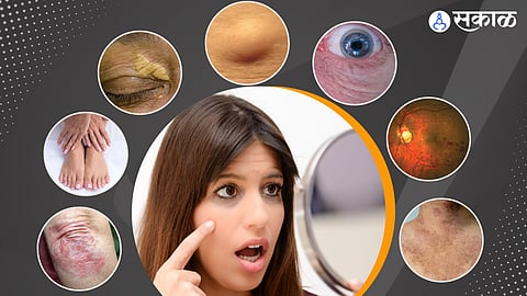 Symptoms of High Cholesterol