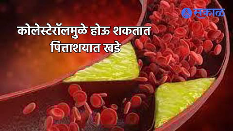 Symptoms Of Gallstones