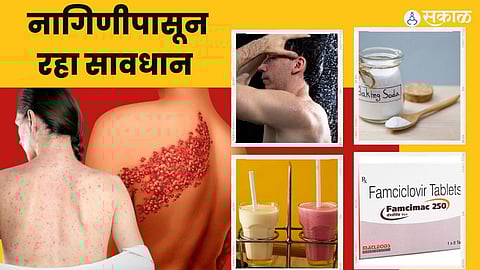 nagin disease causes and Home Remedies