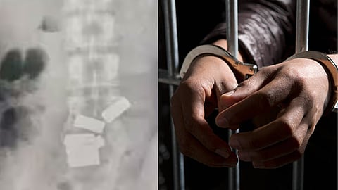 smuggler swallows 8 gold bars JJ hospital doctors gives 3 liter water 1 dozon bananas to retrieve