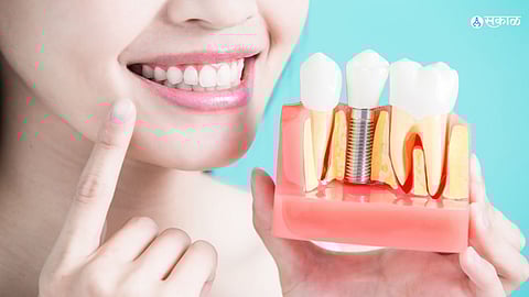 Dental Implants : पडलेल्या दातांमुळे बिघडलंय हास्य? ही आहे सुंदर दंतपंक्तीसाठी जादूची छडी !
