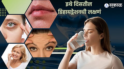 dehydration symptoms