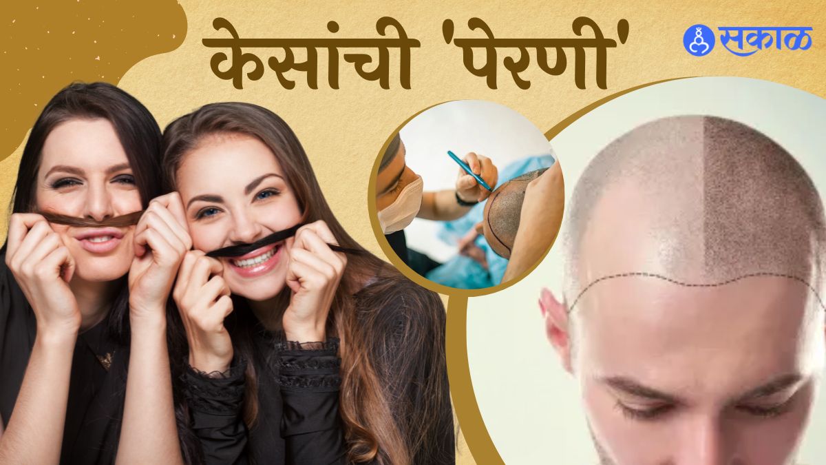 Hair Transplant Techniques