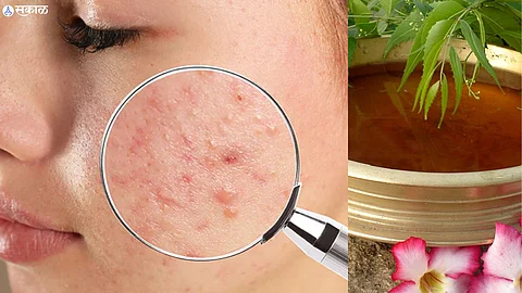 Pimple Remedy