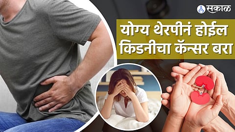 किडनाचा कॅन्सर होऊ शकतो बरा