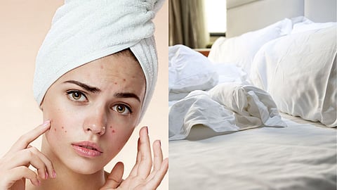 dirty bed sheets and skin health issues