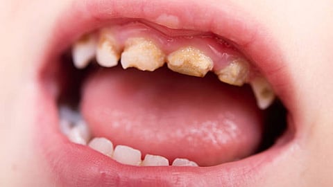 Teeth Cavity Remedies