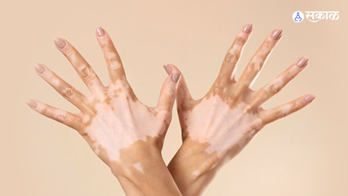 Vitiligo Disease