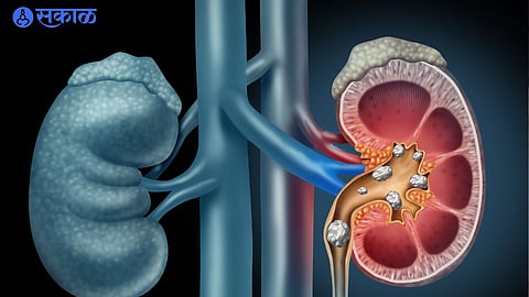 Kidney Stones Remedies