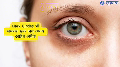 Dark Circles Remedy