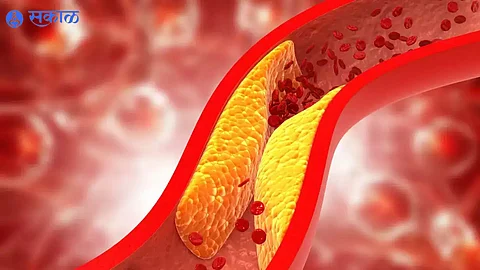 High Cholesterol Symptoms