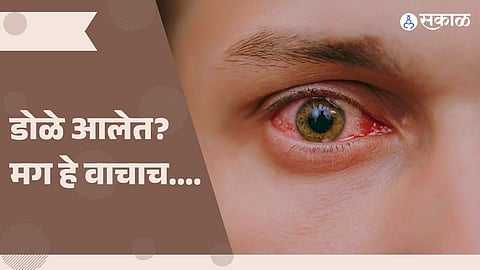 डोळे आल्यावर घ्यायची काळजी