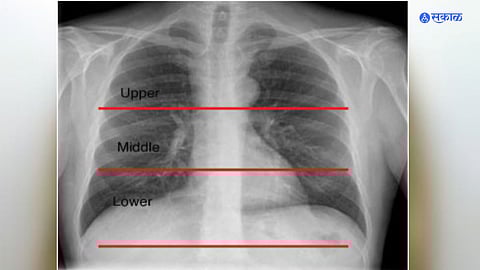 researchers develop new ai model that can tell individuals age from chest x ray