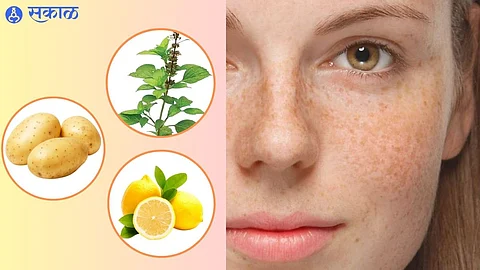 Pigmentation Home Remedies